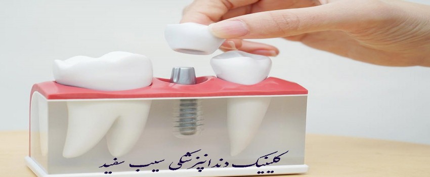 ایمپلنت دندان از چه چیزی ساخته شده است