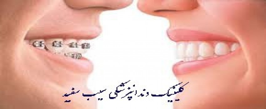 تفاوت لمینت دندان و ارتودنسی