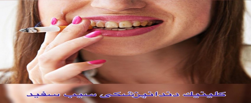 آماری تجربی از تاثیر سیگار بر لمینت یا کامپوزیت دندان