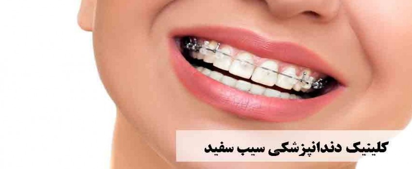 لمینت سرامیکی چه مشکلاتی را برطرف میکنند؟