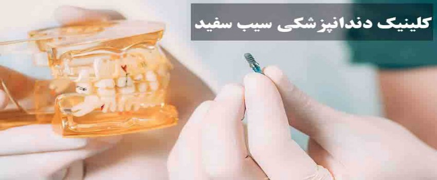 چرا باید از ایمپلنت استفاده کنیم؟