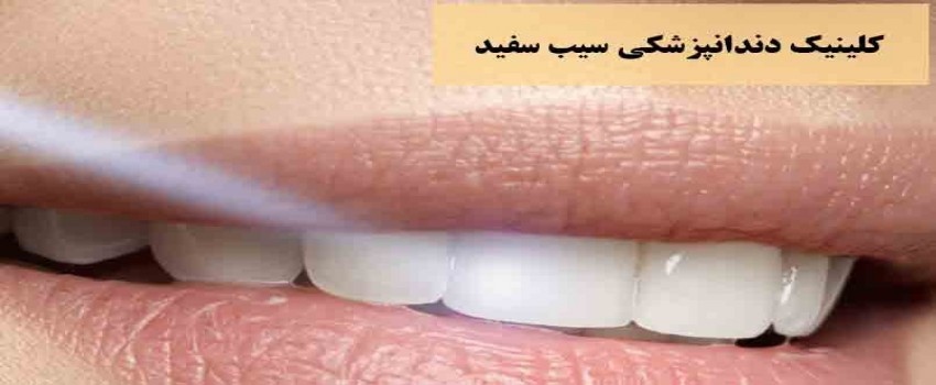 همه نکته هایی که لازم است قبل از کامپوزیت دندان بدانید