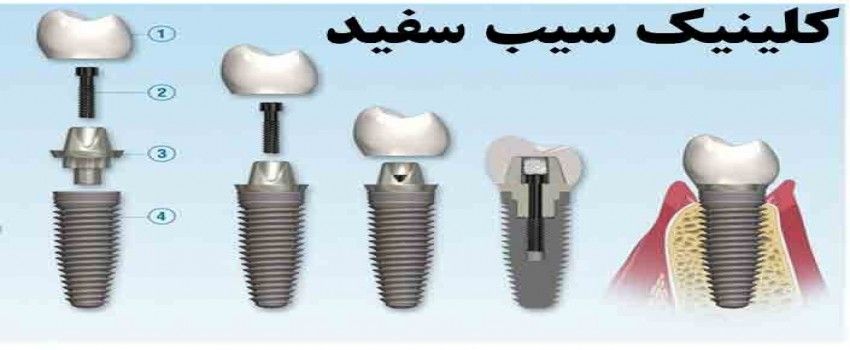 مراحل کاشت ایمپلنت