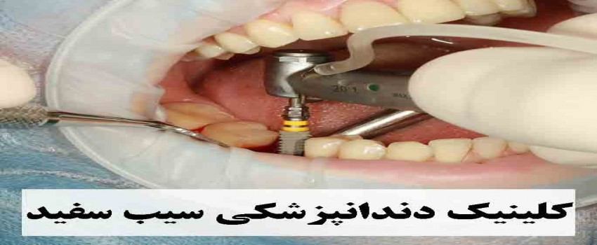 قیمت و انواع کاشت ایمپلنت دندان