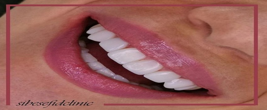 زیبا سازی دندان با کامپوزیت دندان