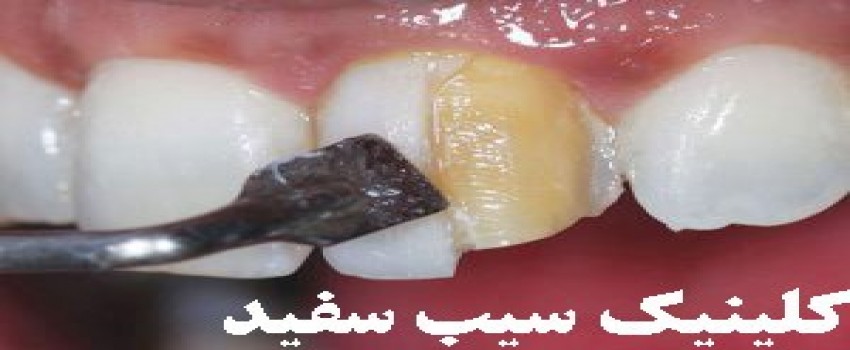 خراب شدن دندان بعداز انجام کامپوزیت ونیر