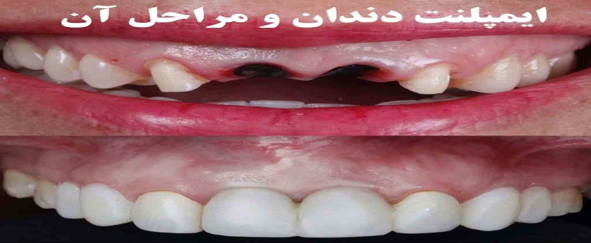 چه کسانی نمی توانند ایمپلنت انجام دهند؟