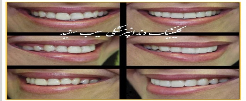 راز طبیعی بنظر رسیدن کامپوزیت ونیر چیست؟