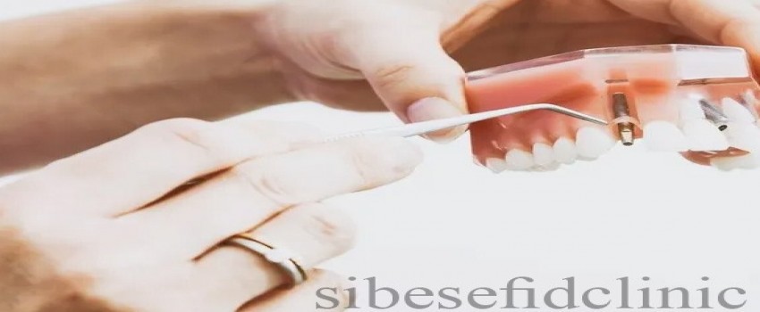 ایمپلنت دندان جلو و هزینه آن