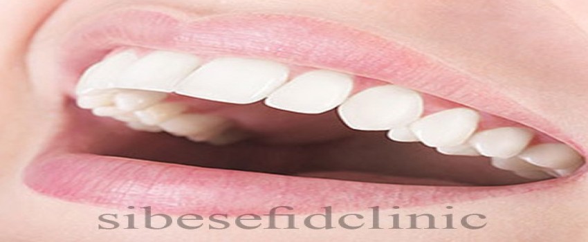 تراش دندان برای لمینت سرامیکی