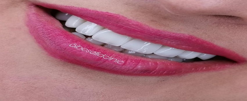 انتخاب نوع و رنگ مناسب لمینت سرامیکی