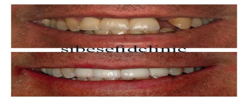 آیا انجام ایمپلنت محدودیت سنی دارد؟