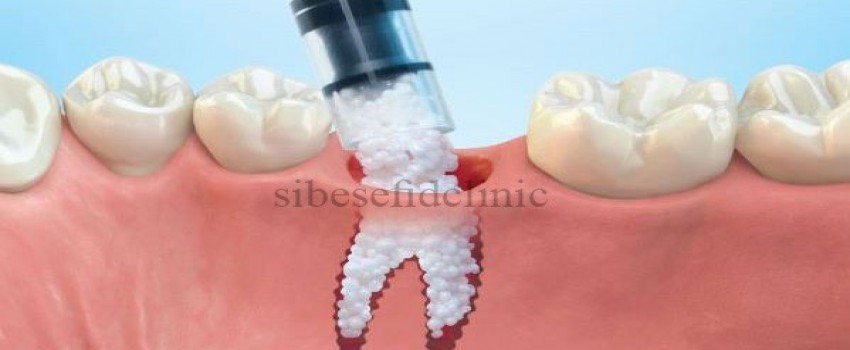 مراقبت وعوارض پیوند استخوان ایمپلنت