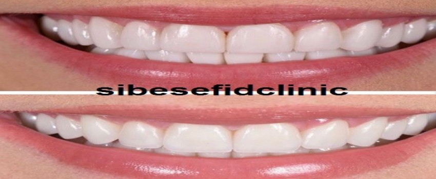 براى بستن فاصله بین دندانها چه راهکاری وجود دارد؟