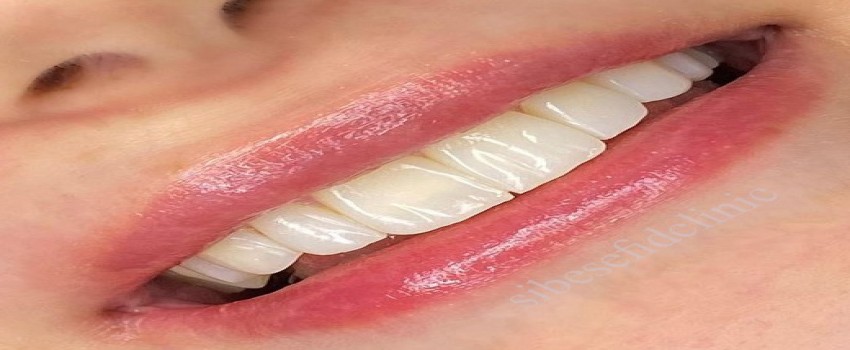 اصلاح رنگ، نامرتبى و شکل دندانها به روش کامپوزيت ونیر در يک جلسه درمان.