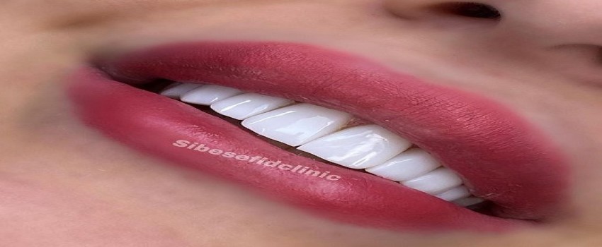 آيا درمان لمينت بهتر از کامپوزيت ونیر است؟