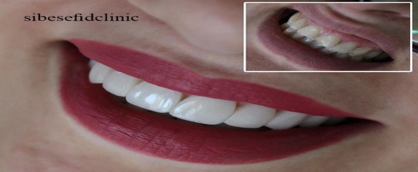 کامپوزیت ونیر چه میزان تراش لازم دارد؟