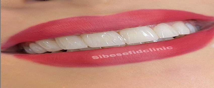 یک برند خوب کامپوزیت چه ویژگیهایی نسبت به کامپوزیت های دیگر دارد؟