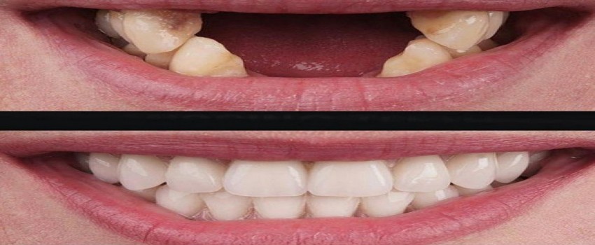 مراقبت های بعد از انجام ایمپلنت دندان