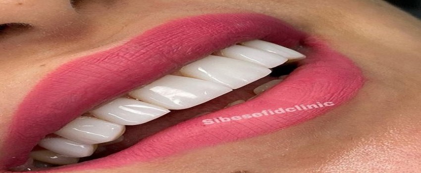 چه چیز باعث طبیعی شدن کامپوزیت دندان میشود؟