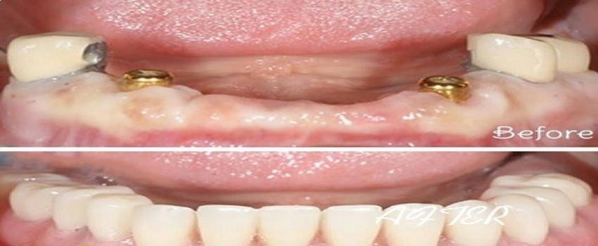 ایمپلنت، بهترین جایگزین برای دندان از دست رفته