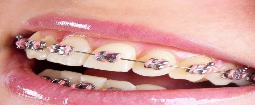 سن مناسب برای ارتودنسی دندان