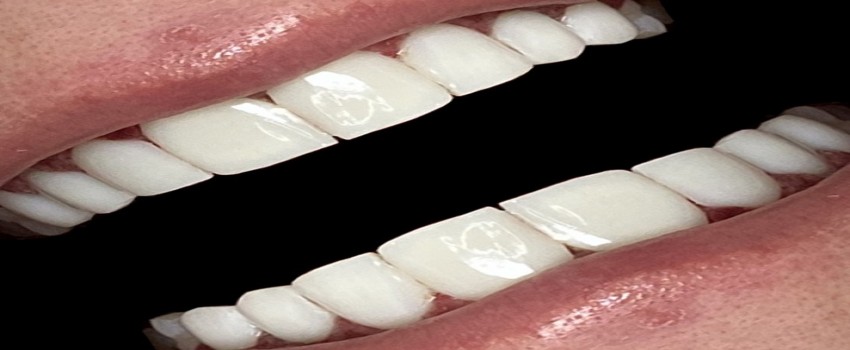 ضخامت کامپوزیت دندان