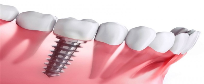 علت تفاوت قیمت در ایمپلنت دندان