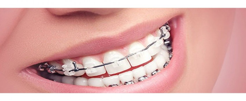 آیا دندان پر شده را میتوان ارتودنسی کرد؟