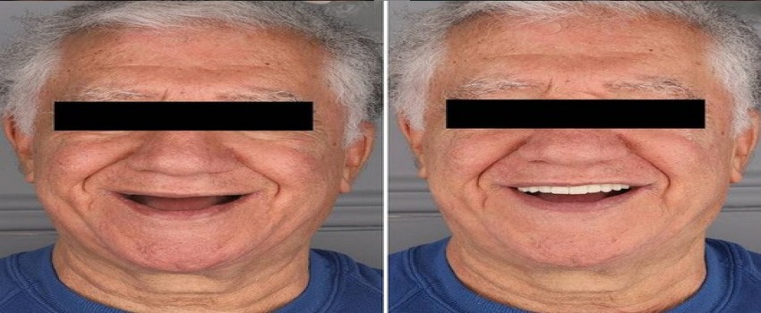 مراحل مراقبت و انجام ایمپلنت دندان