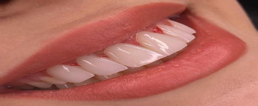 مراحل انجام و نصب کامپوزیت ونیر