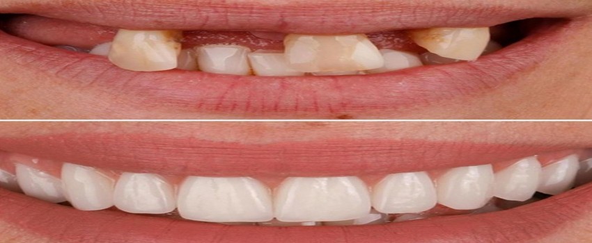 در چه مواردی از ایمپلنت کاشت دندان استفاده می شود؟