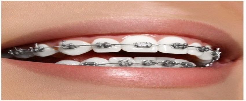 ارتودنسی در دوران بارداری