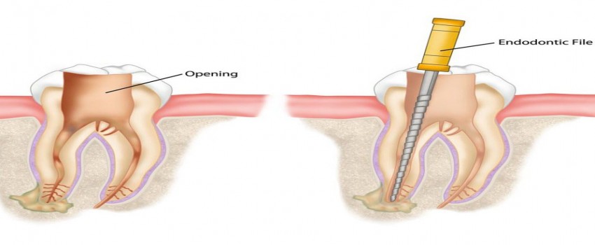 دلایل نیاز شما به عصب کشی دندان چیست؟