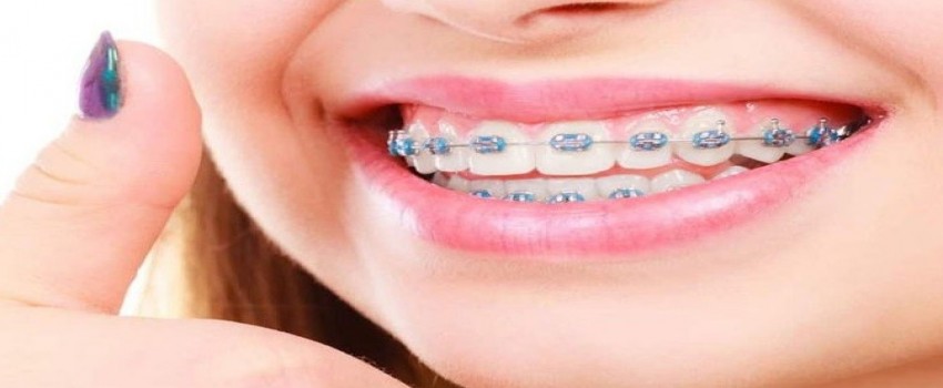 آیا بدون ارتودنسی میتوان دندان ها را مرتب کرد؟