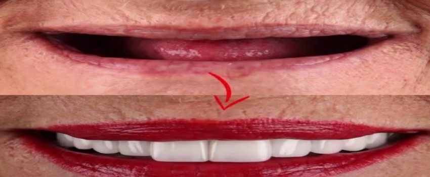 آیا میتوان چند سال بعد از کشیدن دندان ایمپلنت انجام داد؟