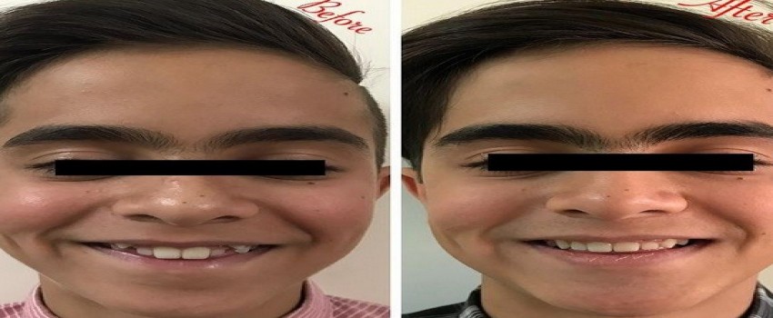 مدت زمان درمان ارتودنسی