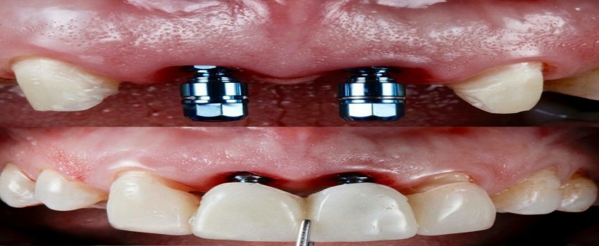 مراقبت های بعد از عمل جراحی ایمپلنت