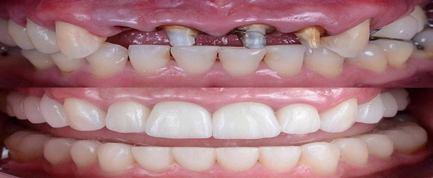 معرفی درمان ریشه یا روت کانال تراپی‌