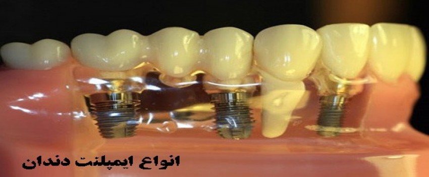 فرآیند جراحی و کاشت ایمپلنت دندان‌ها به چه صورت است؟