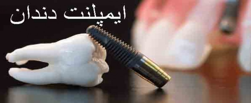 مراحل جراحی و کاشت ایمپلنت دندان