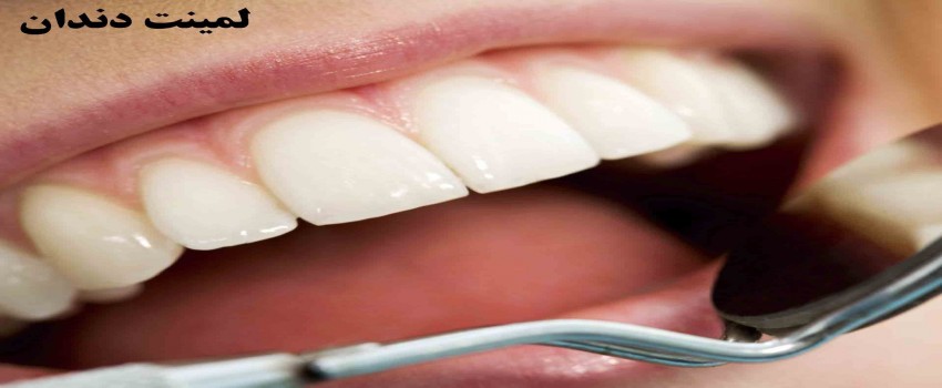 همه چیز درباره لمینت های سرامیکی