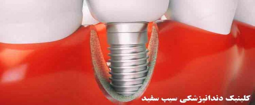 چه کسانی نمی توانند ایمپلنت دندانی انجام دهند؟ ‌