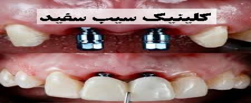 هر آنچه باید درباره ایمپلنت و مراقبت های بعد از آن بدانید