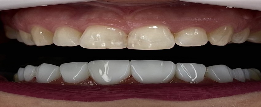 5 راه تضمینی برای افزایش ماندگاری کامپوزیت دندان