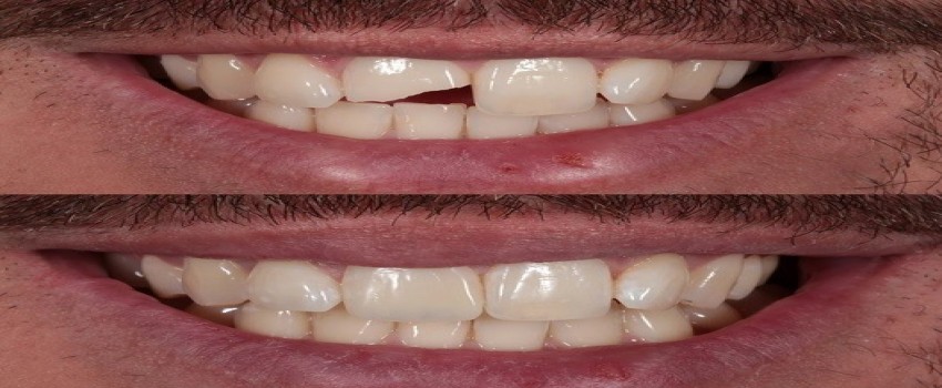 مزایای کامپوزیت ونیر و طول عمر آن