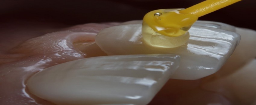 مزایا و معایب داشتن روکش های دندان