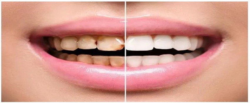 علت تفاوت قیمت در لمینت و کامپوزیت دندان