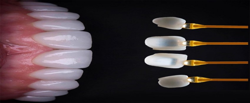 آیا لمینت سرامیکی دائمی است؟