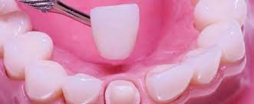 تفاوت روکش و لمینت